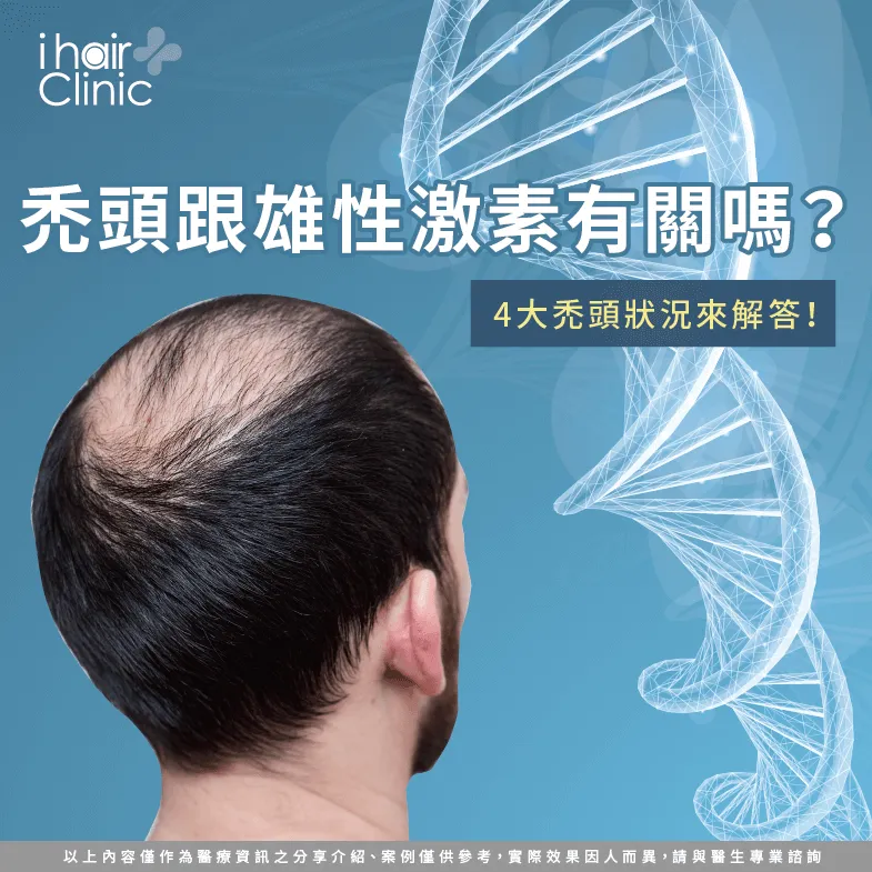 雄性荷爾蒙 禿頭-禿頭 雄性激素