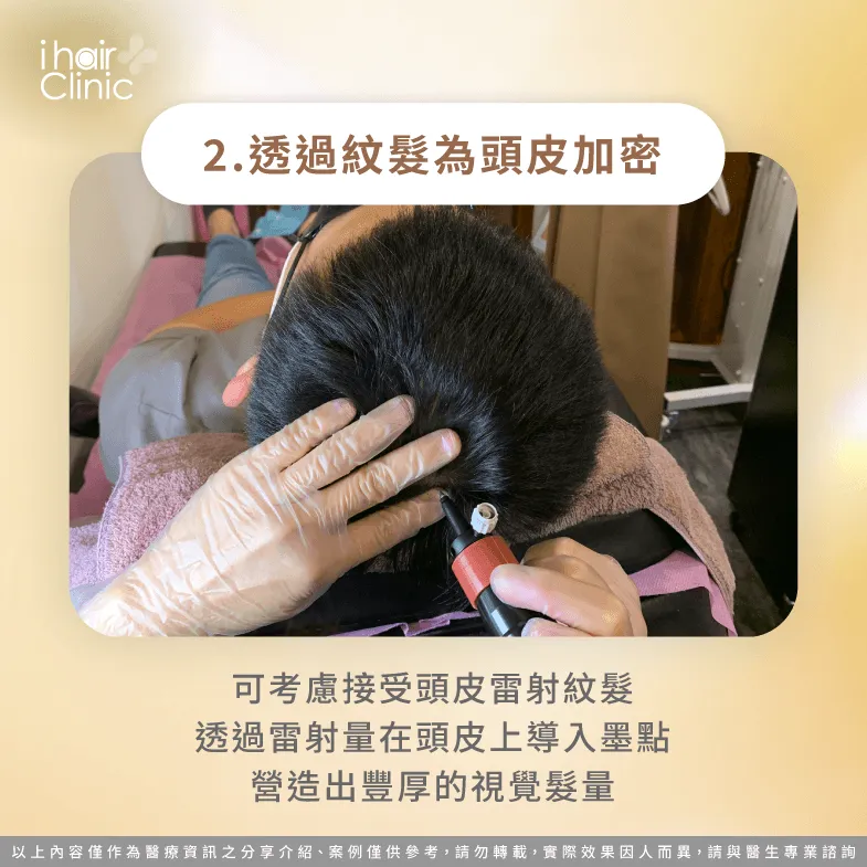 接受LSMP仿真毛囊雷射,可將墨點導入頭皮表層,藉此營造出濃密視覺髮量 頭皮紋髮可打造豐厚視覺髮量-增髮 植髮