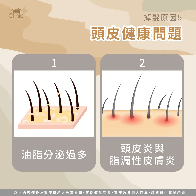 頭皮健康問題造成掉髮-掉髮是什麼原因