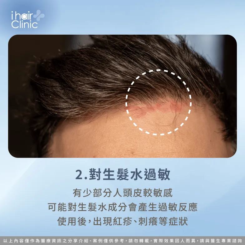 部分人對生髮水成分可能產生過敏反應-生髮水 落髮