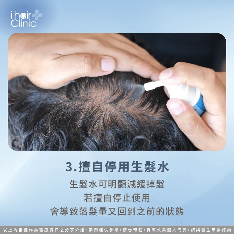 停用生髮水會讓髮量恢復到使用前的狀態-使用生髮水 掉髮