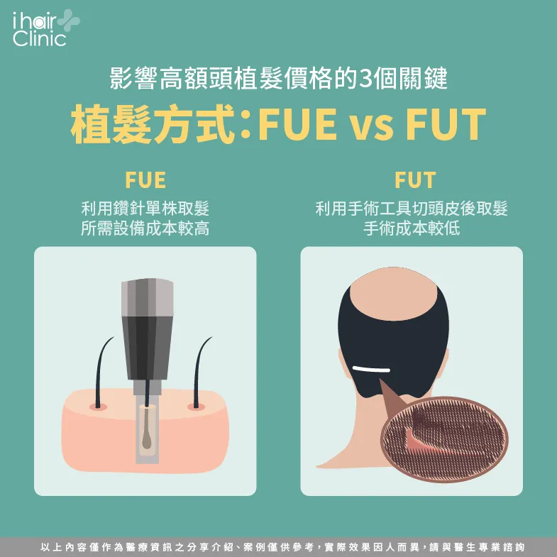 FUE、FUT植髮價格不同-高額頭植髮價格