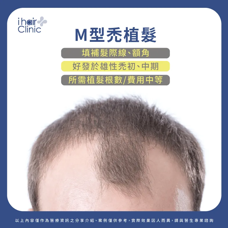 M型禿植髮-雄性禿植髮價錢