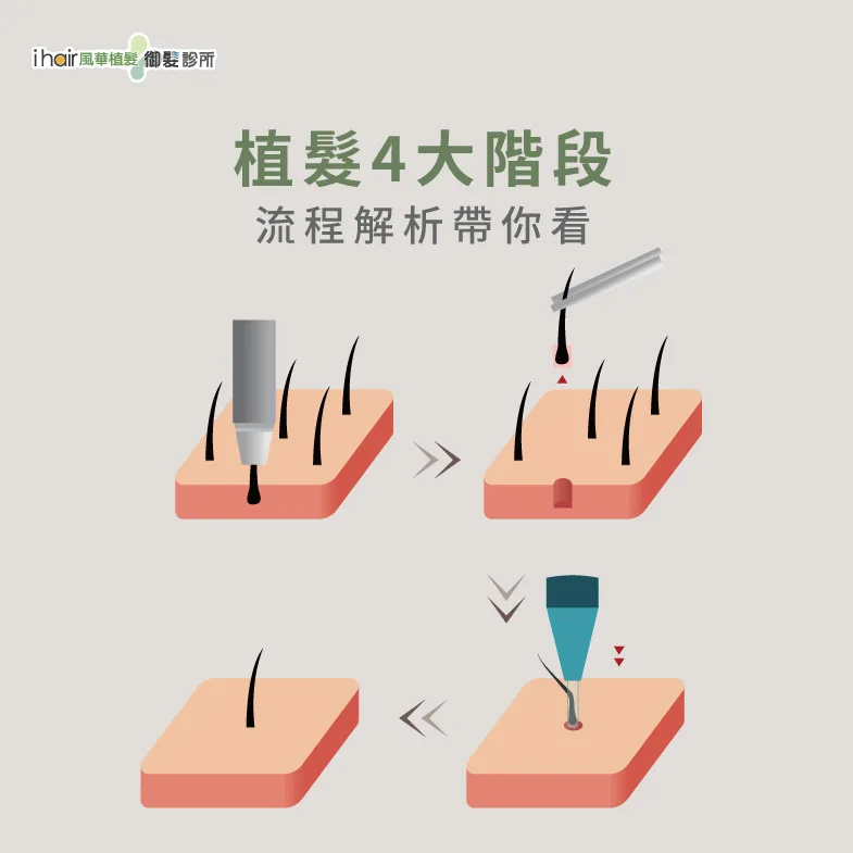 4大植髮階段-植髮過程