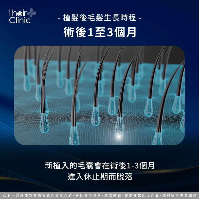 術後休止期掉落- 植髮後會自然生長嗎