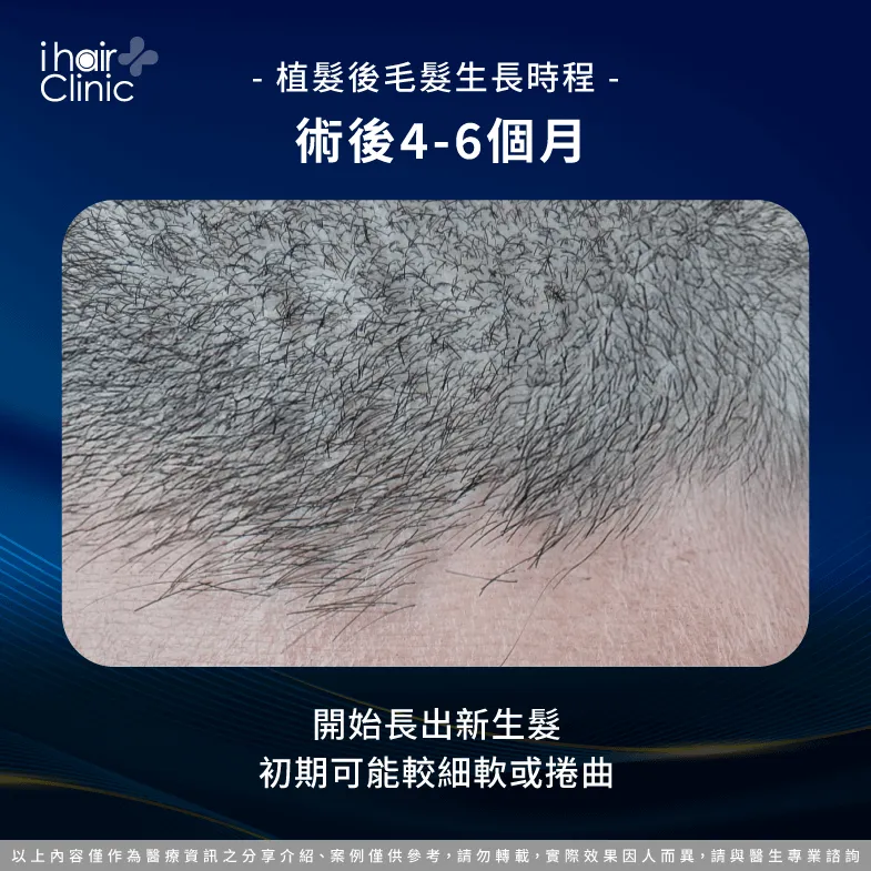 4-6個月新髮生長期- 植髮後會自然生長嗎