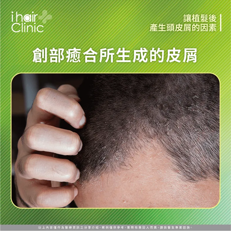 正常的頭皮代謝-植髮會有頭皮屑嗎