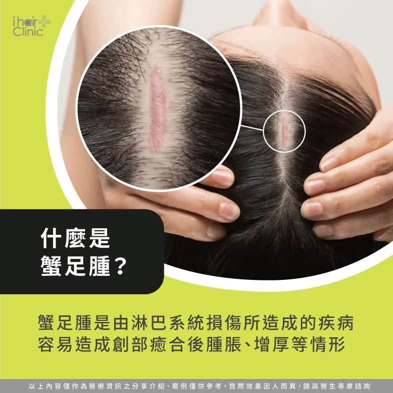 什麼是蟹足腫-蟹足腫可以植髮嗎