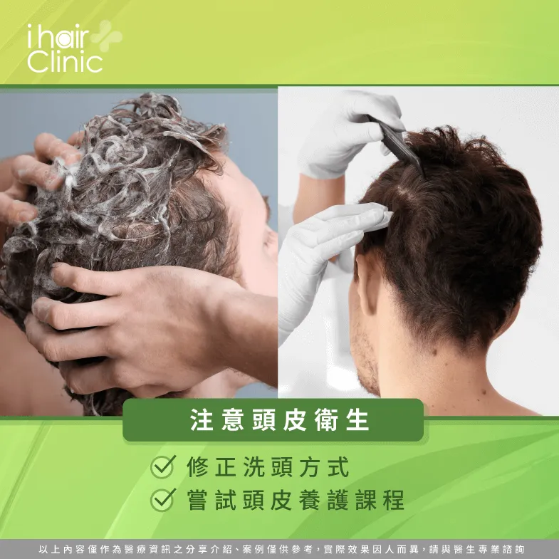 正確清潔頭皮-髮旋禿怎麼辦