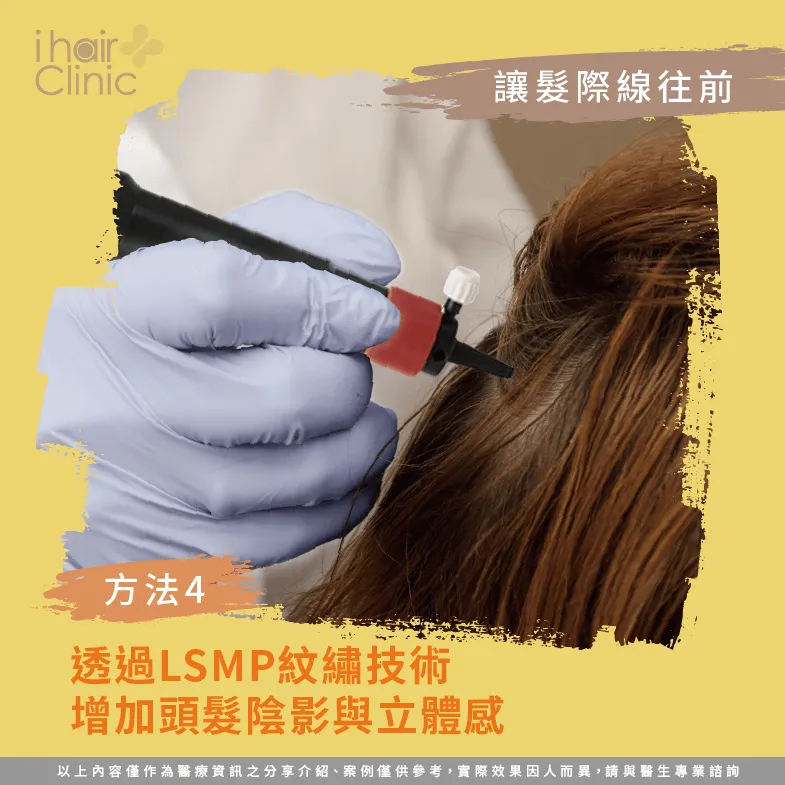 LSMP紋髮技術-如何讓髮際線往前