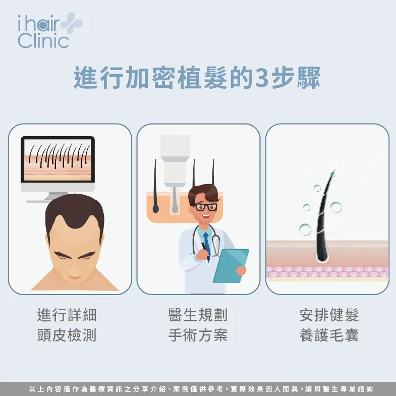 加密植髮手術的3個流程-加密植髮