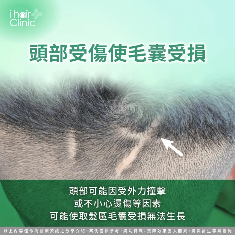 頭部受撞擊或燙傷導致取髮區毛髮無法生長-取髮區 掉髮