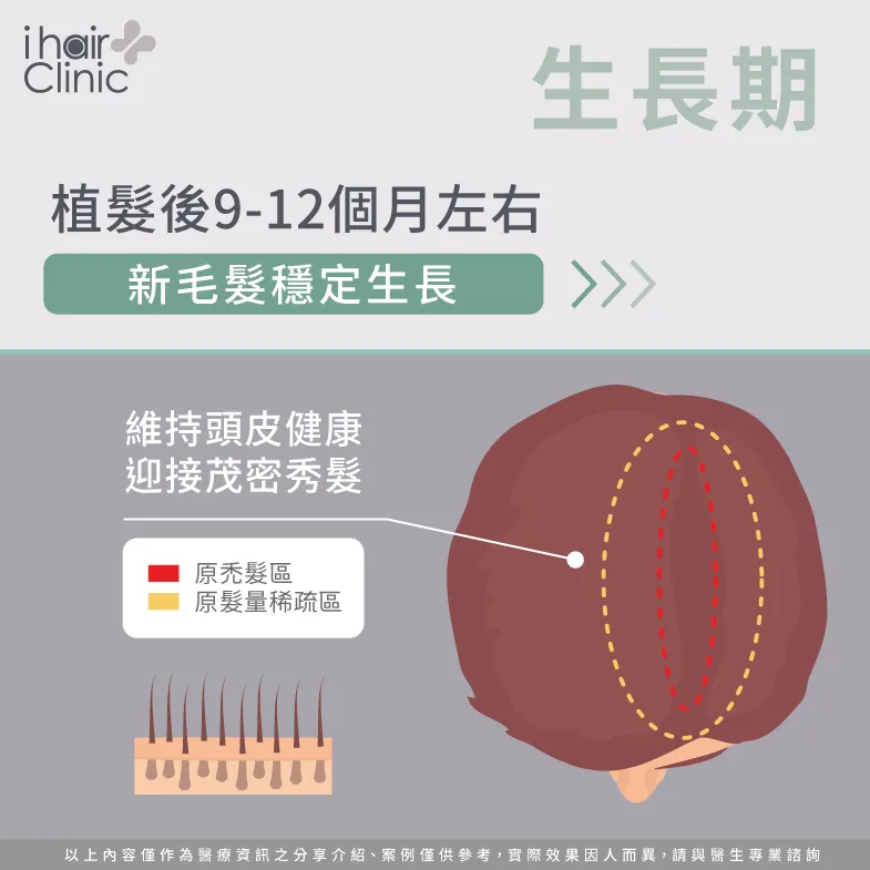 植髮後9-12個月髮絲穩定生長-植髮休止期掉髮