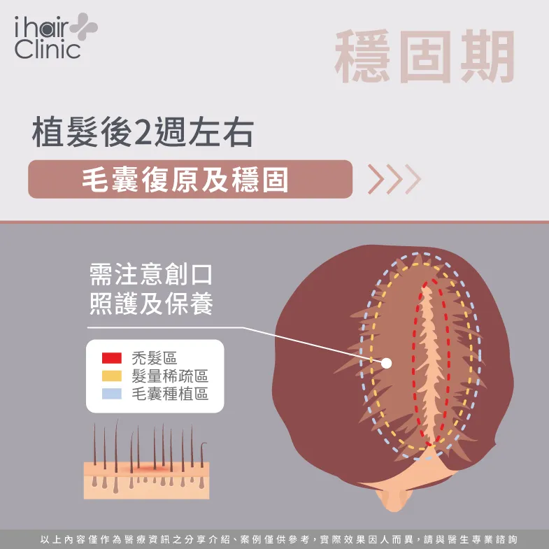 植髮後2週維修復穩固期-植髮休止期掉髮