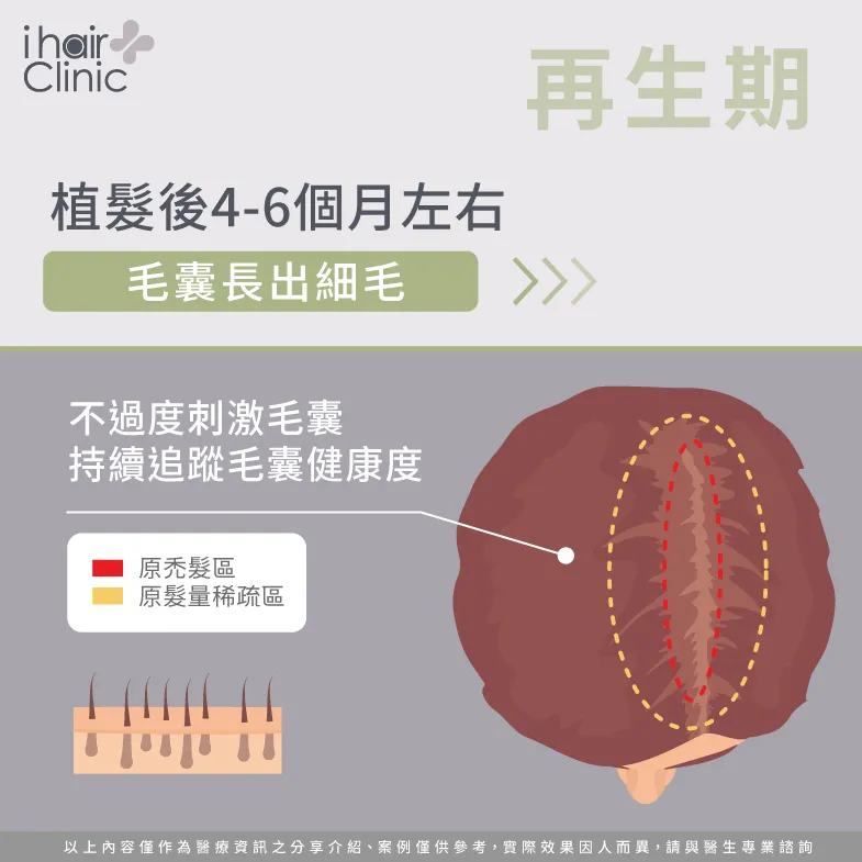 植髮後4-6個月毛囊將新生毛髮-植髮休止期掉髮