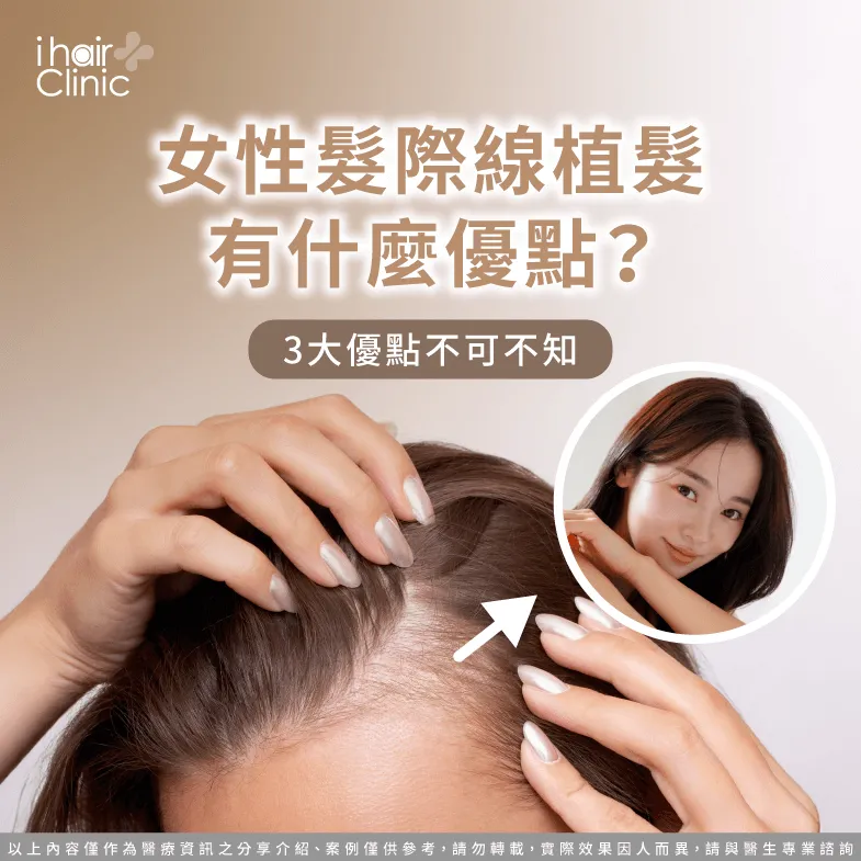 女生植髮際線3個優點全解析-女性髮際線植髮
