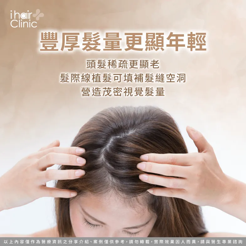 填補髮際線可幫助打造豐厚髮量-女生植髮際線