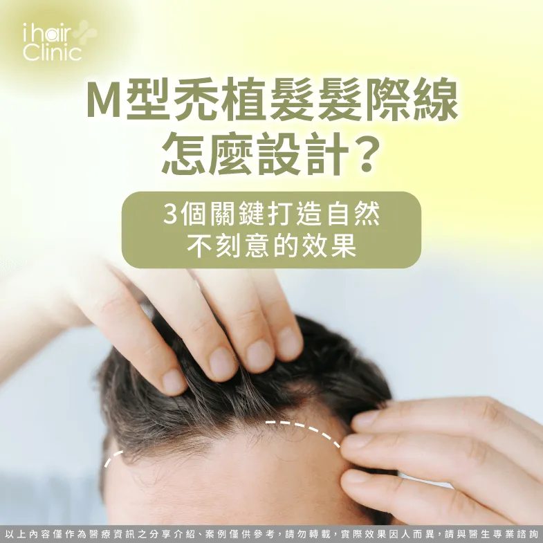 M型禿 植髮 髮際線設計-植髮 髮際線 自然
