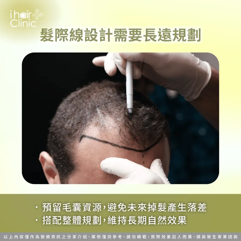 長期規劃-M型禿 植髮 髮際線設計