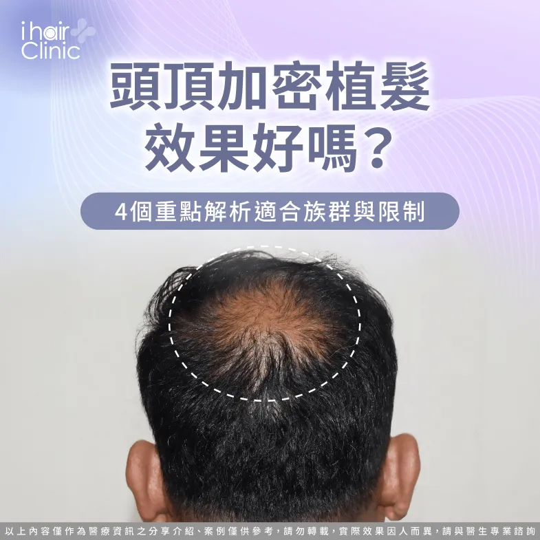 頭頂加密植髮效果好嗎?4個重點解析適合族群與限制 頭頂加密植髮 效果-頭頂植髮 加密