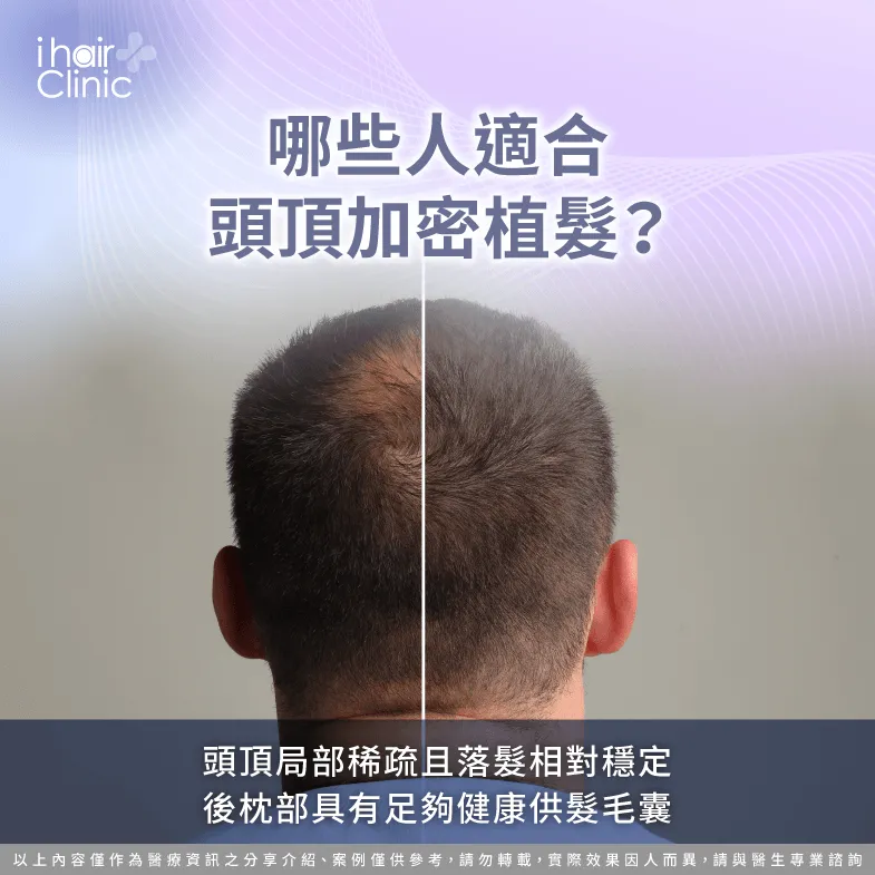 哪些人適合頭頂加密植髮?先確認落髮與供髮條件 適合植髮族群-頭頂加密植髮 效果