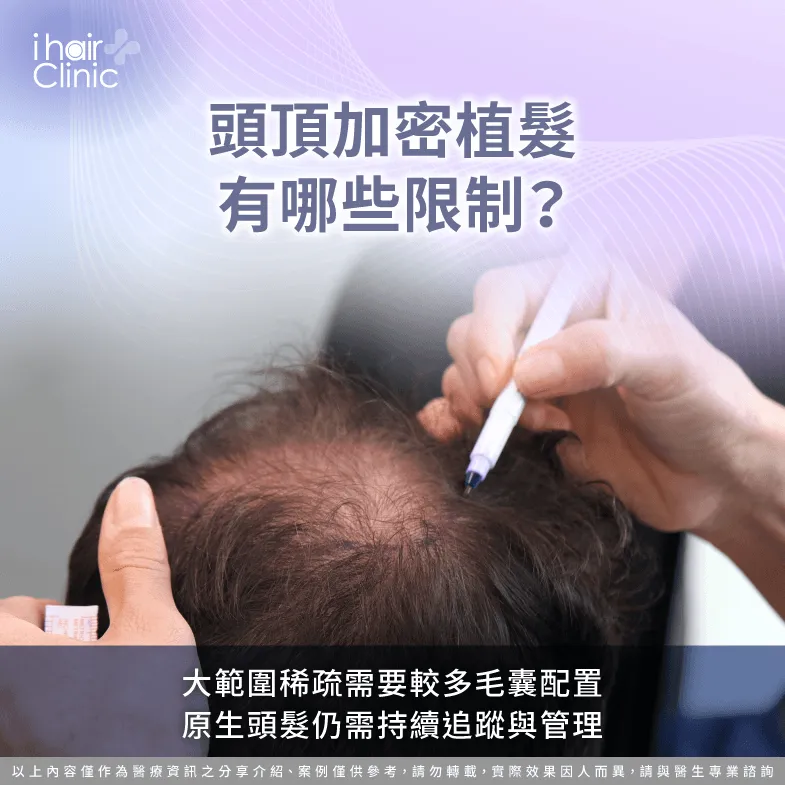 頭頂加密植髮限制有哪些?毛囊數量與原生髮是關鍵 頭髮加密限制-頭頂加密植髮 效果
