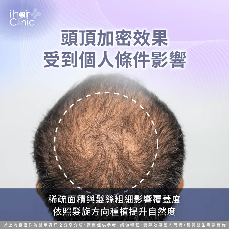 頭頂加密植髮效果受稀疏範圍與髮旋方向影響 頭頂加密植髮條件-頭頂加密植髮 效果