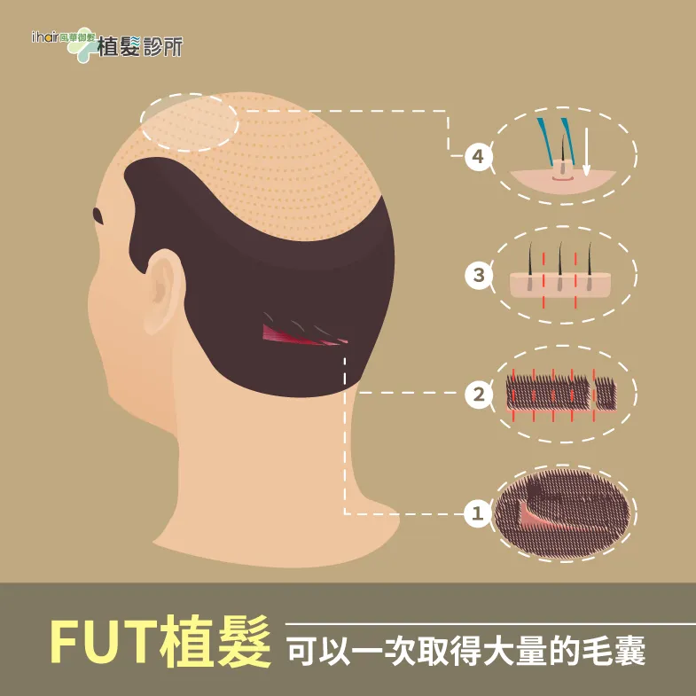 fut植髮可以一次獲得大量毛囊-植髮fue和fut的差異