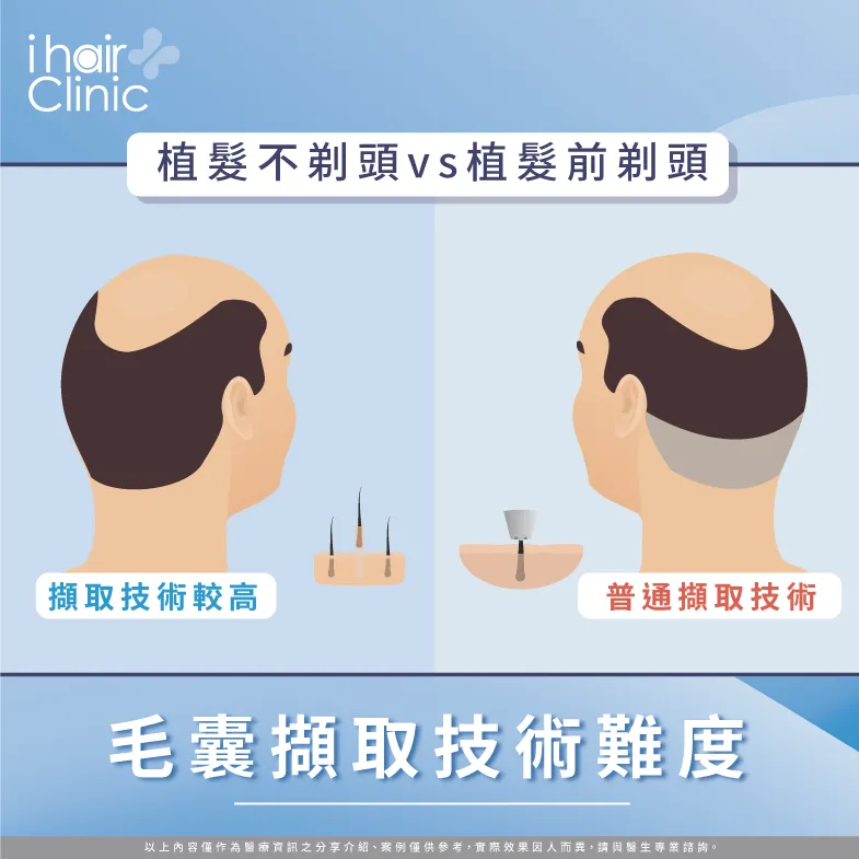 毛囊擷取技術難度-植髮不剃頭可以嗎