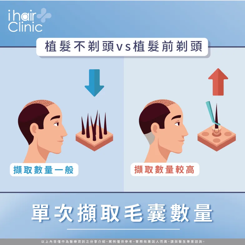 單次可擷取的毛囊數量-植髮不剃頭可以嗎