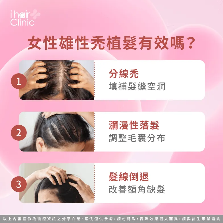 女生雄性禿植髮的3個改善重點一次看-女生雄性禿 植髮