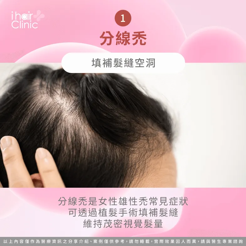 植髮可幫助填補髮縫空洞-女性雄性禿 植髮