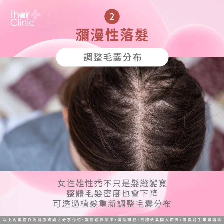 植髮可重新分配毛囊種植密度與分布-女生雄性禿 植髮