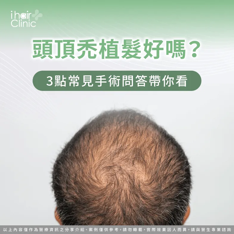 頭頂禿植髮3個手術優點一次看-頭頂禿 植髮