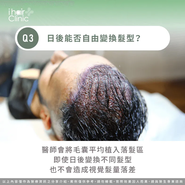 待毛髮穩定生長即可自由變換髮型-頭頂禿 植髮