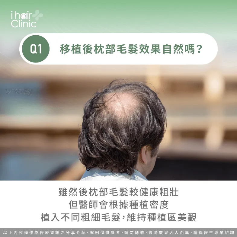醫師會植入不同粗細毛髮以維持美觀-頭頂禿 植髮