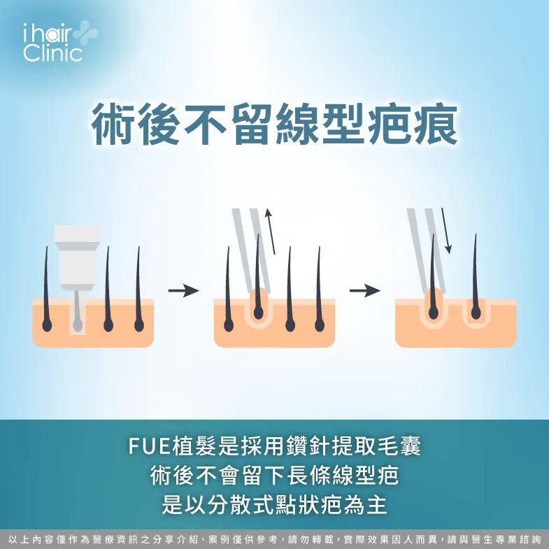 FUE植髮術後僅會留下微小點狀疤痕-fue 植髮 疤痕
