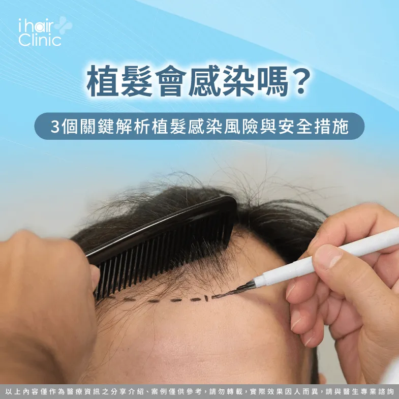 植髮會感染嗎-植髮 感染