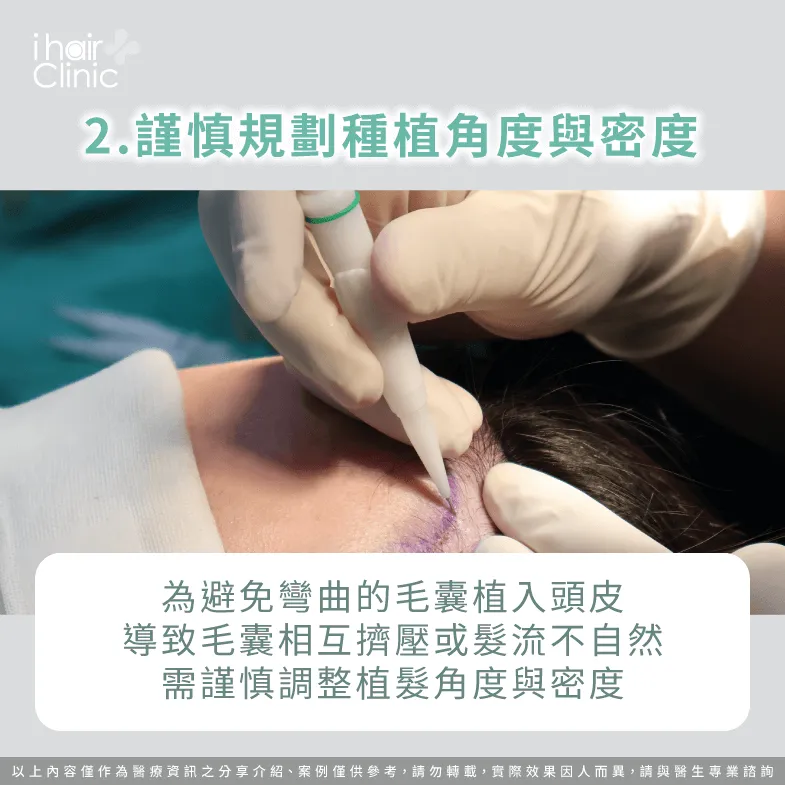 即使是捲髮也需按照髮流進行種植-植髮 捲髮