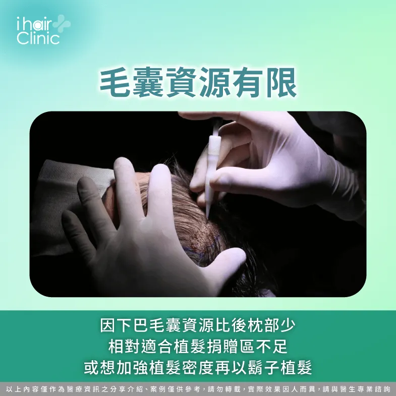 需適度提取下巴毛囊避免影響美觀-植髮可以用鬍子嗎