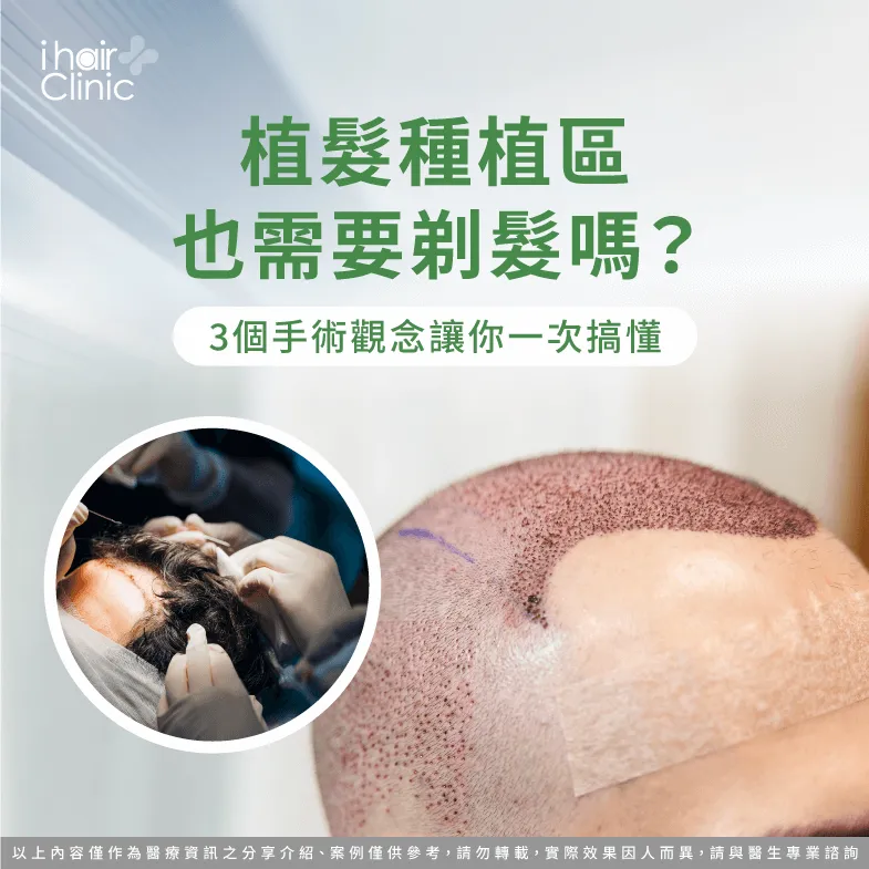 3個觀念解析植髮種植區是否需剃髮-植髮 種植 區