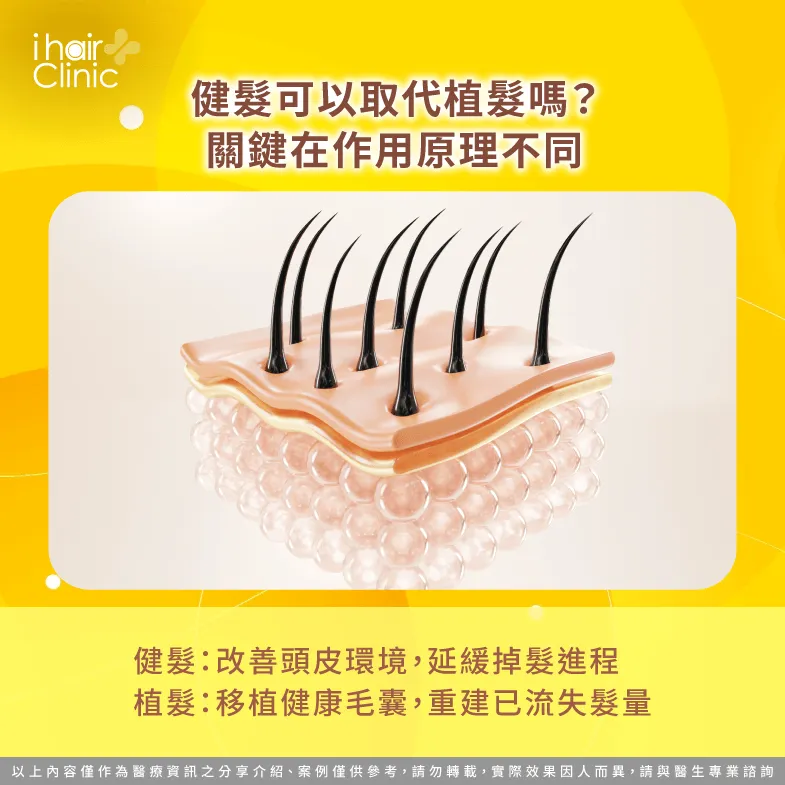 健髮與植髮原理-健髮 可以取代植髮嗎