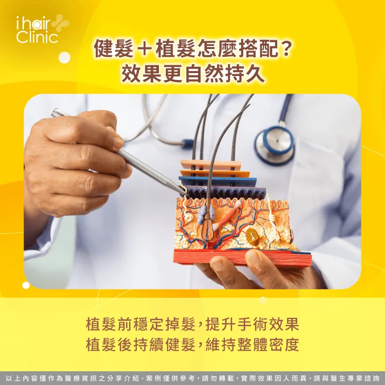 健髮植髮搭配-健髮 可以取代植髮嗎