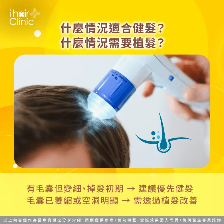 適合健髮與植髮的情況-健髮 植髮 差別
