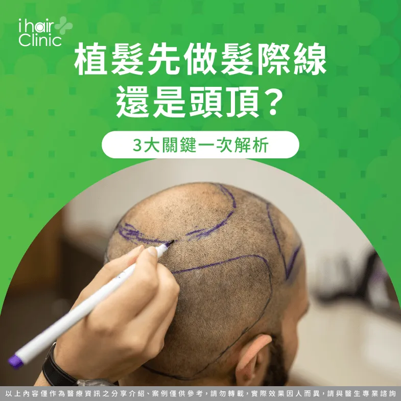 植髮順序解析:髮際線與頭頂規劃關鍵一次看 植髮規劃先做髮際線還是頭頂-植髮 髮際線 頭頂