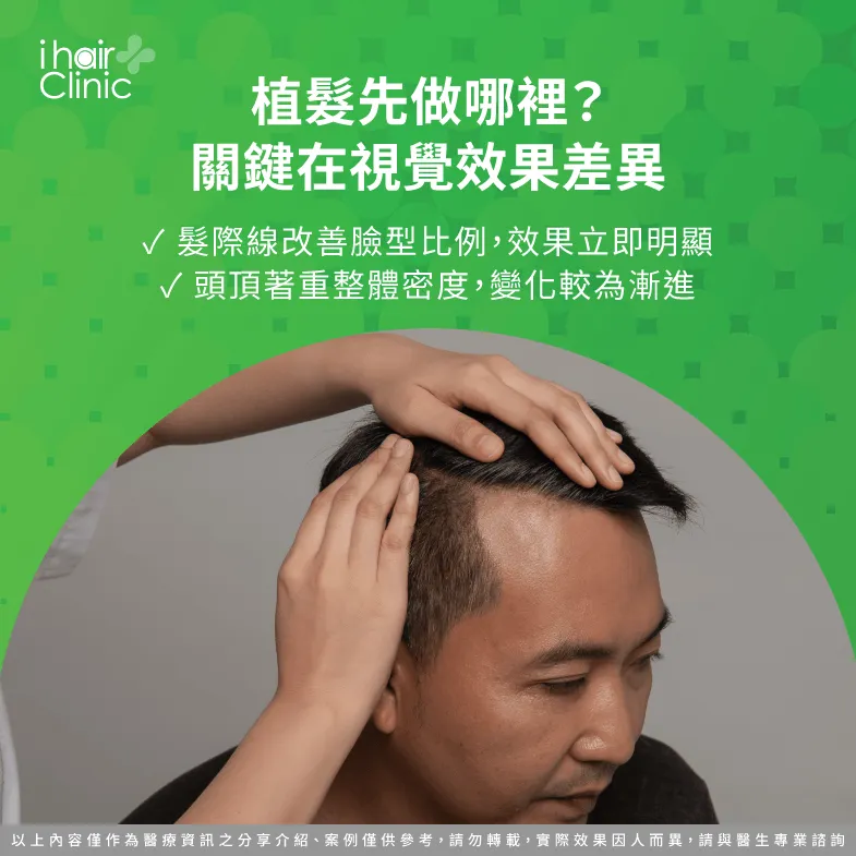 髮際線與頭頂植髮差異:視覺效果與改善重點 視覺效果與需求-植髮規劃先做髮際線還是頭頂