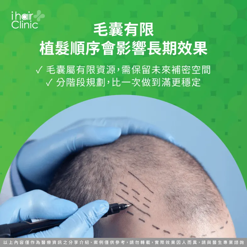 毛囊資源有限怎麼規劃?植髮順序與長期效果 毛囊資源有限-植髮規劃先做髮際線還是頭頂