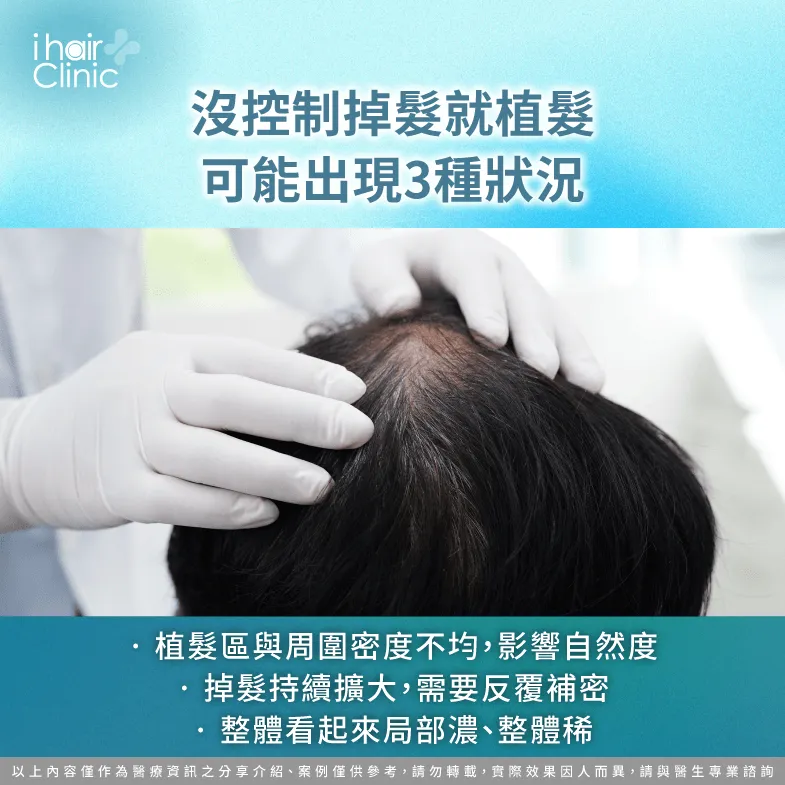 未控制掉髮-植髮前 掉髮控制