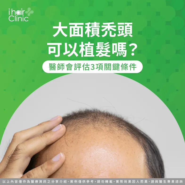 大面積禿頭植髮評估:供髮區、禿髮範圍與毛囊配置 大面積禿頭可以植髮嗎-大面積禿頭植髮 效果