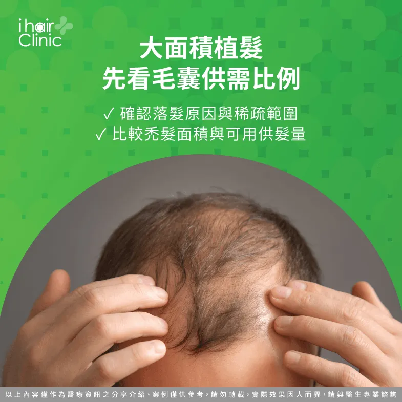 大面積植髮需要多少毛囊?從禿髮範圍評估毛囊供需比例 禿髮範圍-大面積禿頭可以植髮嗎